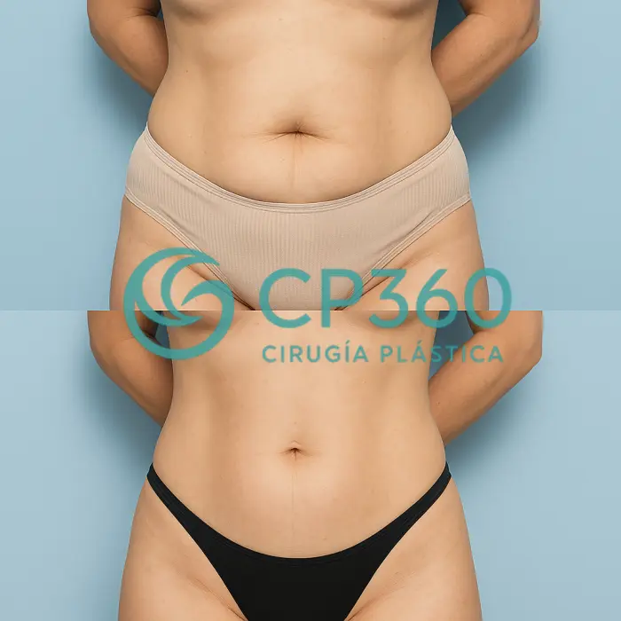 Galería de Lipoescultura