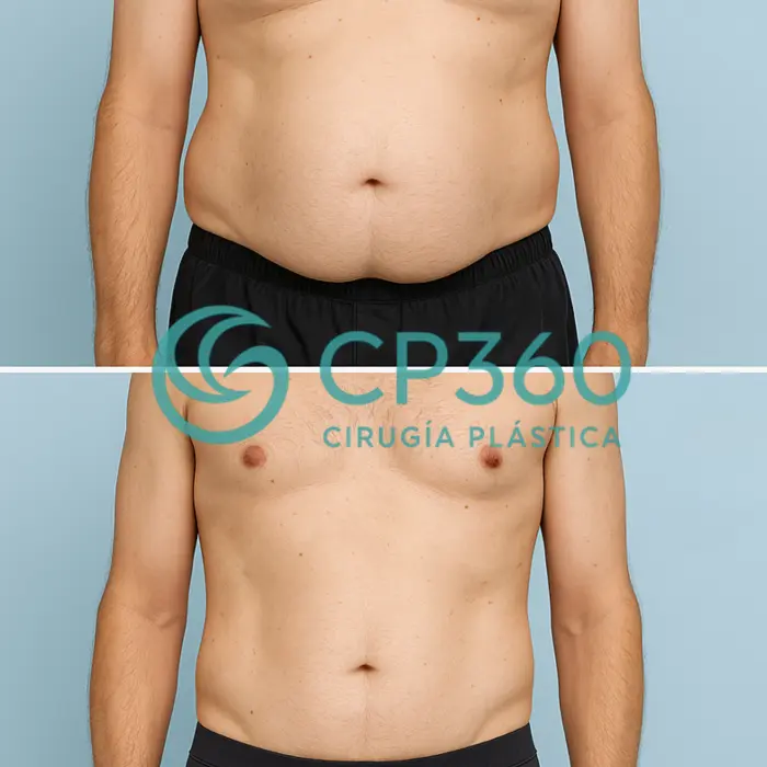 Galería de Lipoescultura
